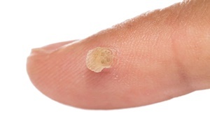 Ketuat adalah penyakit kulit yang berkesan melawan Skincell Pro